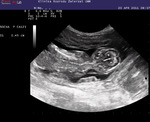 BP изображение за 27 дней до родов
