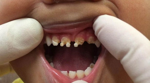 Знімки вражають і жахають: що міститься в напоях цукор просто знищив зуби малюків: